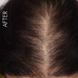 Laser Light Vibration Brush Therapy + Hair Follicle Stimulator Formula + Microneedling Hair Device