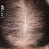 Laser Light Vibration Brush Therapy + Hair Follicle Stimulator Formula + Microneedling Hair Device