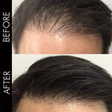 Laser Light Vibration Brush Therapy + Hair Follicle Stimulator Formula + Microneedling Hair Device