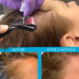 Laser Light Vibration Brush Therapy + Hair Follicle Stimulator Formula + Microneedling Hair Device